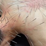 ルート治療の感想