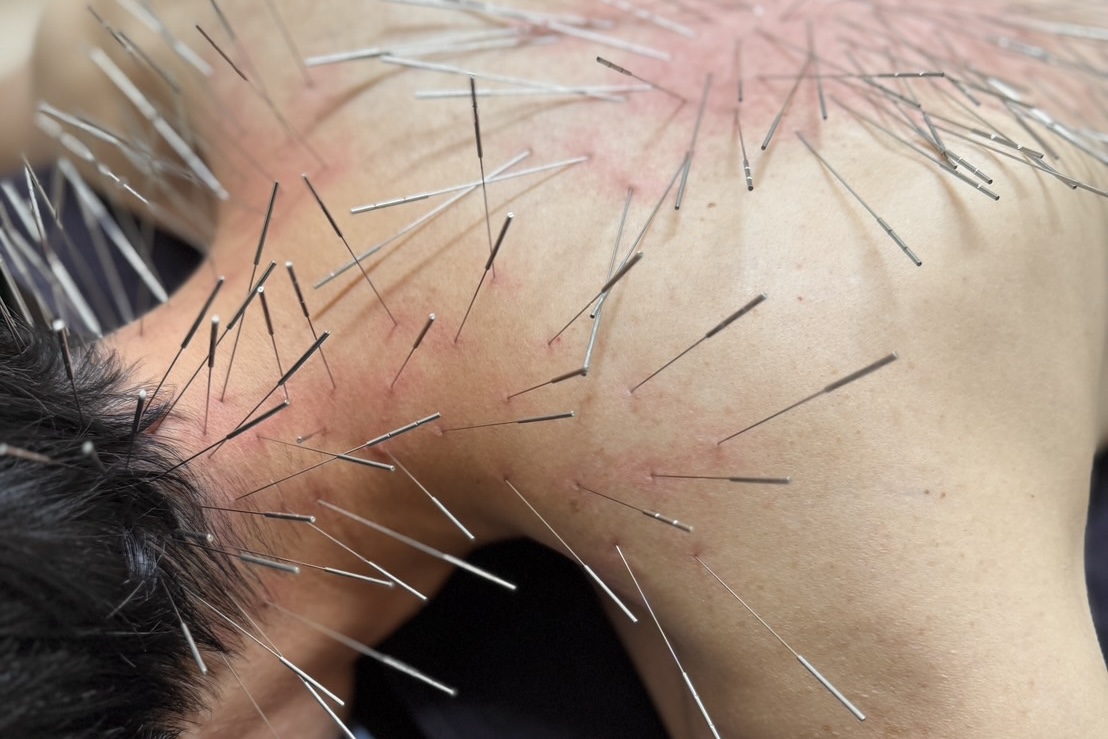 ルート治療の感想